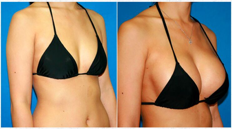 Prima e dopo l'aumento del seno con chirurgia plastica