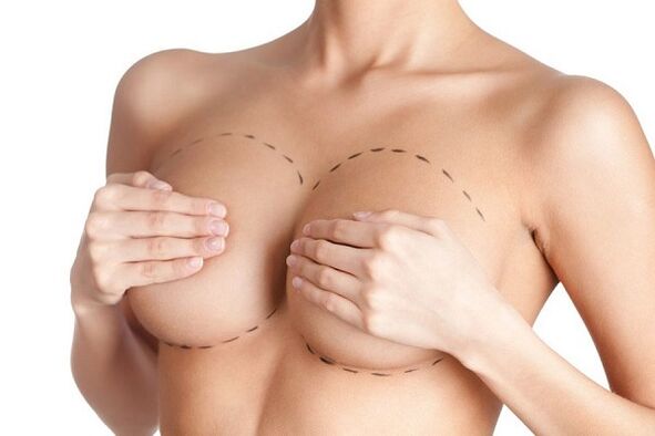 markup per la chirurgia di aumento del seno