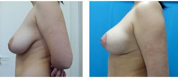 prima e dopo l'aumento del seno chirurgico