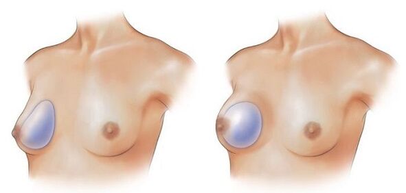 protesi rotonde e a forma di goccia per l'aumento del seno