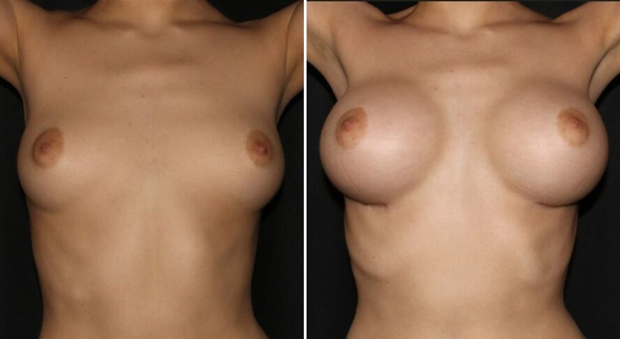 Prima e dopo l'intervento chirurgico di aumento del seno